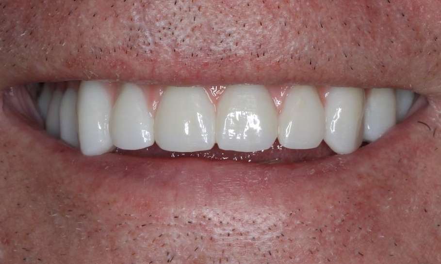 Mans mouth after implant dentures, nashville tn