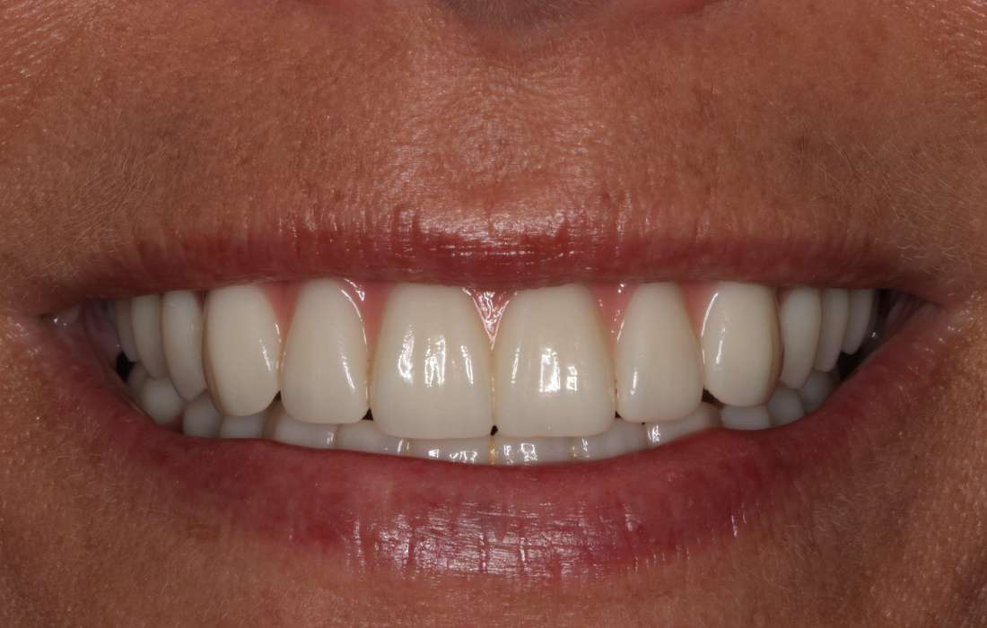Mouth after implant-supported dentures, nashville tn
