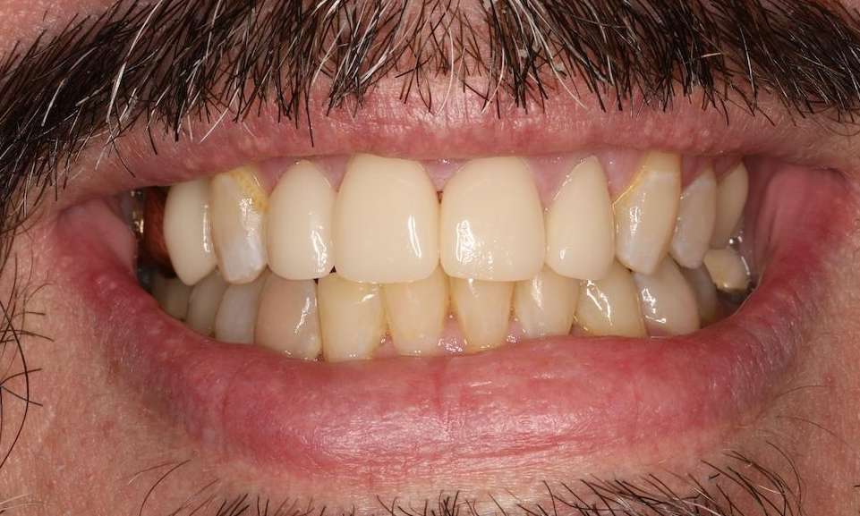 Mans mouth after invisalign and cosmetic crowns, brentwood tn