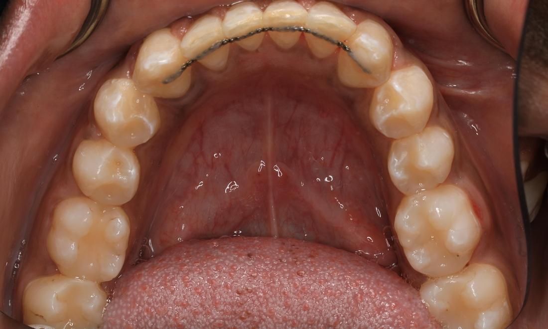 Patient teeth after Invisalign Brentwood, TN