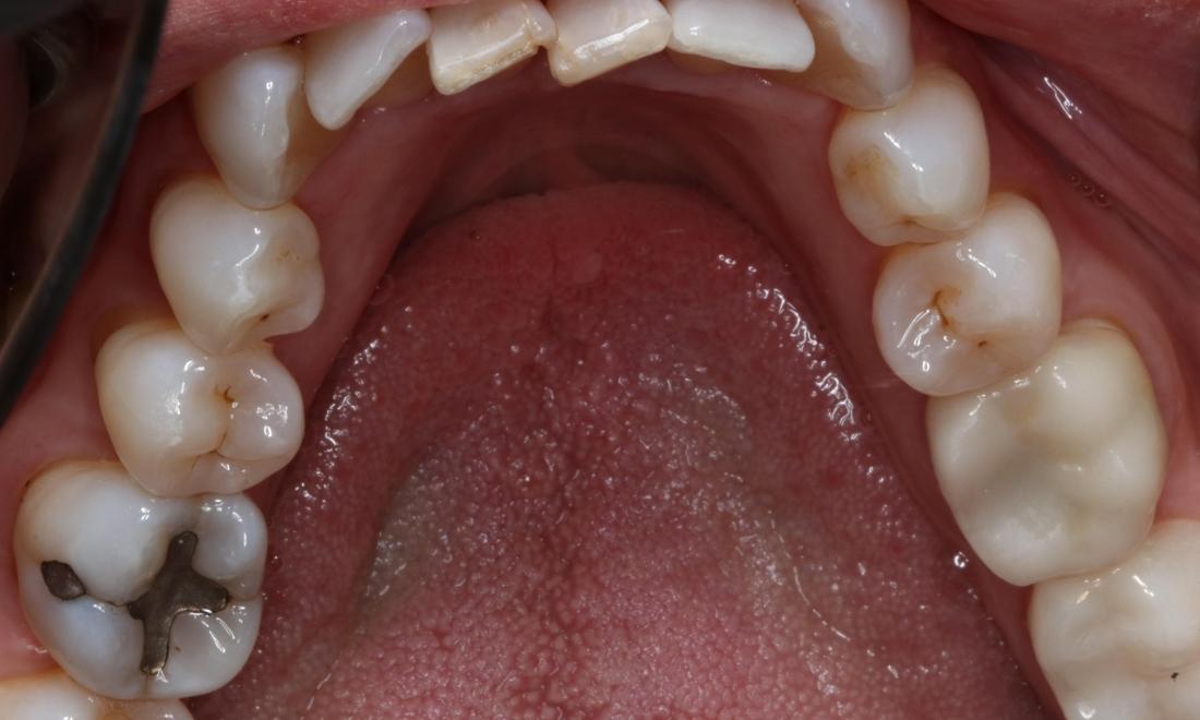 Patient after Lingual Tori treatment in Brentwood, TN