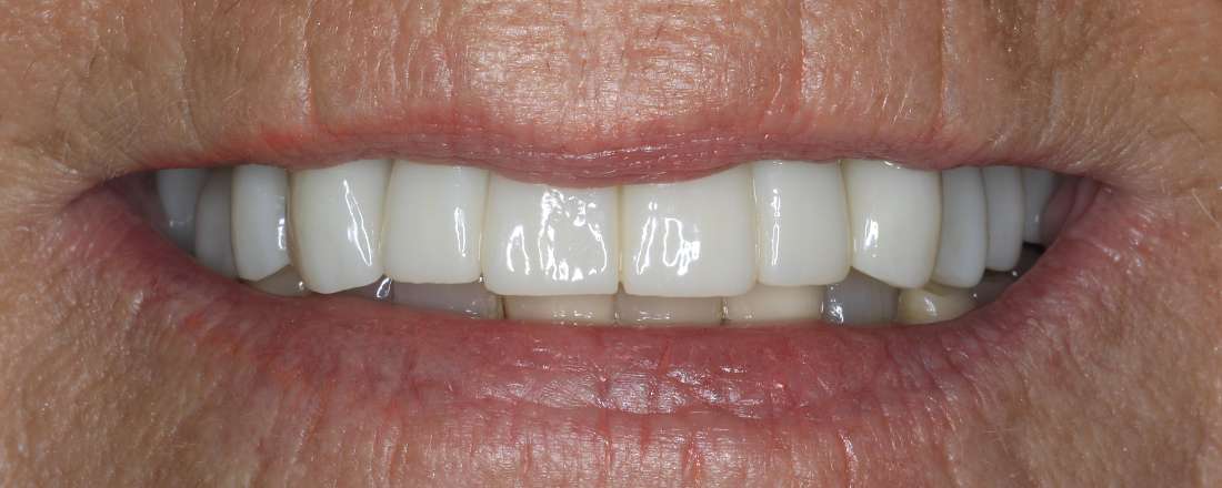 Close up view of older woman's smile after a smile makeover, nashville tn