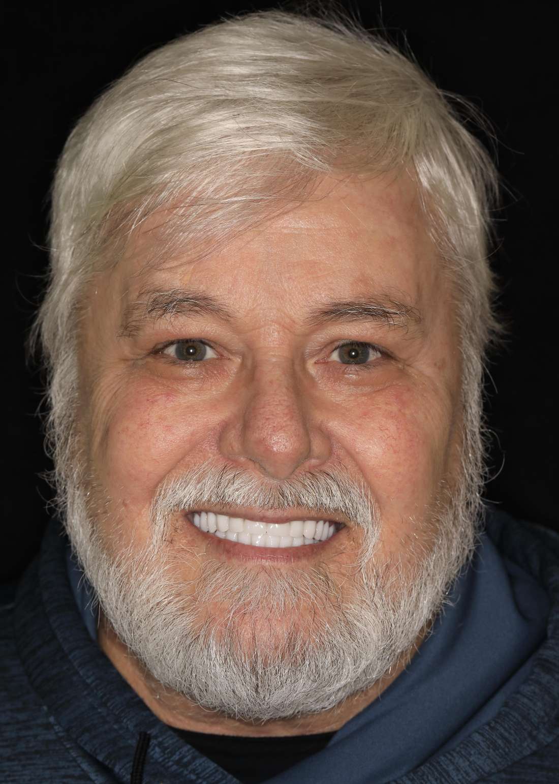 After picture of a man before a Top Denture and Bottom Implant Snap In Denture, nashville tn