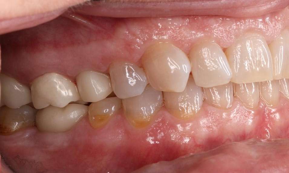 Close up of mouth after dental implants, nashville tn