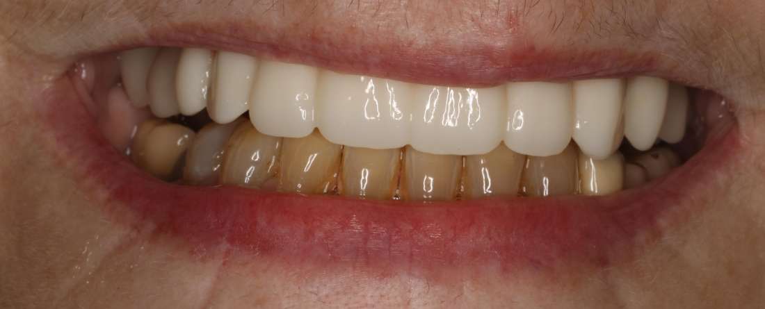 Close up of elderly woman smiling after all-on-x implant dentures, nashville tn