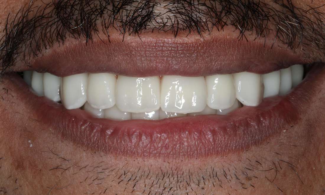 Close up of man smiling after all-on-x implant dentures, nashville tn