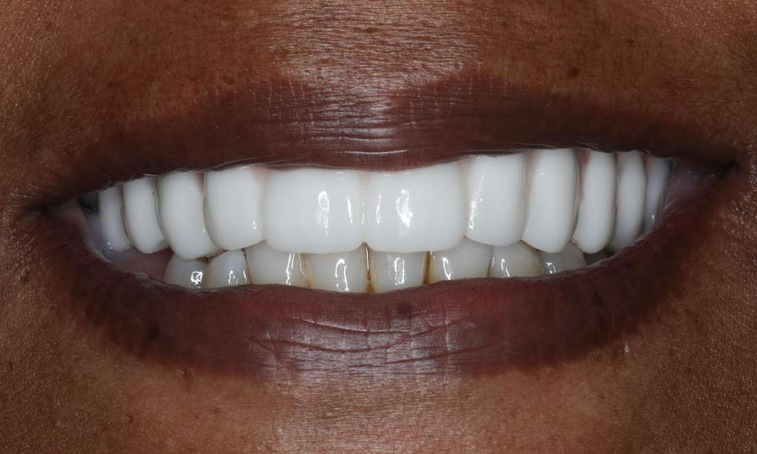 Close up view of woman smiling after all-on-x implant dentures, nashville tn