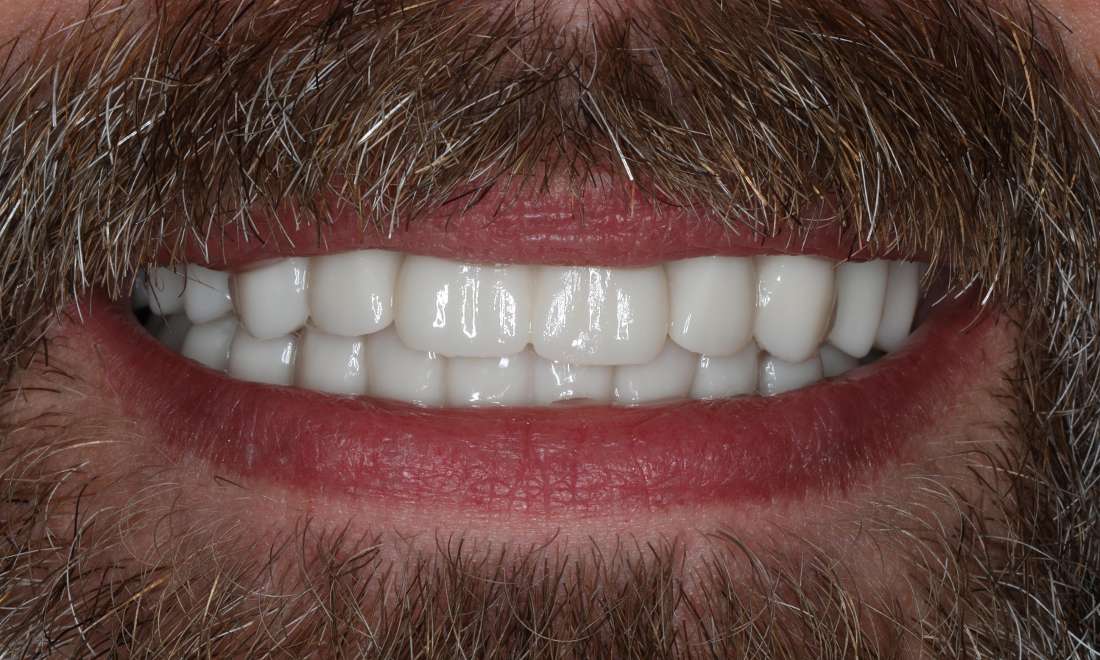 Close up view of bald man smiling after all-on-x implant dentures, nashville tn