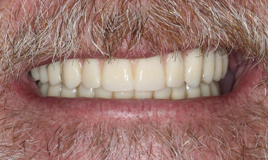 Close up view of older man smiling after all-on-x implant dentures, nashville tn