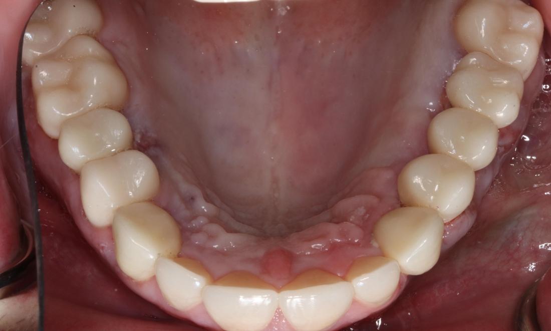 Overhead view of mouth after complete smile makeover, nashville tn