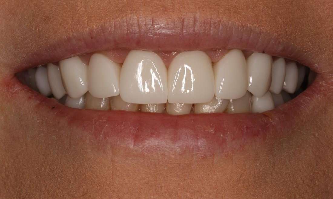 Close up of womans smiling after cosmetic crowns, brentwood tn