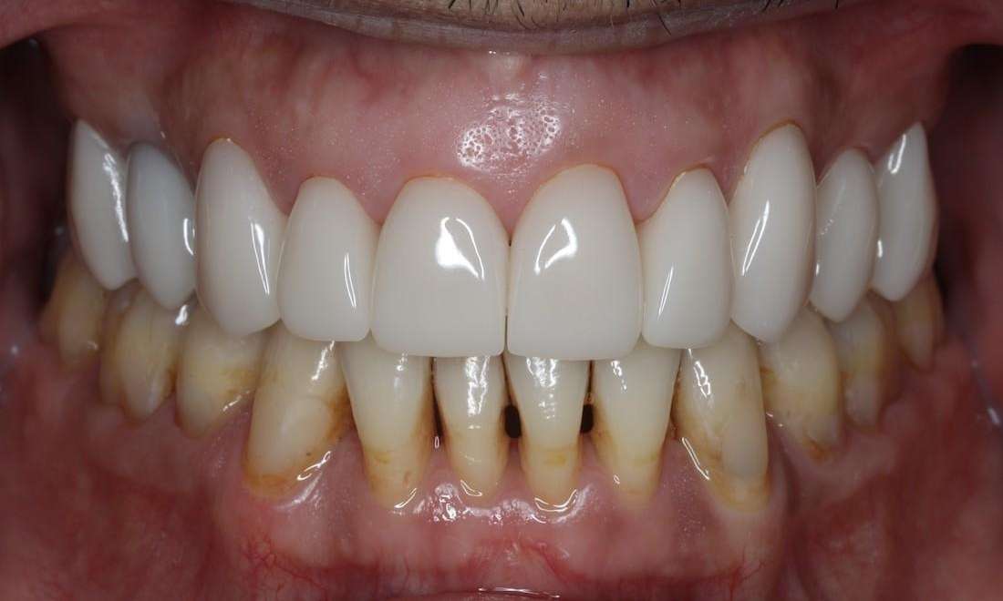 Close up of mans gums after cosmetic crowns, brentwood tn