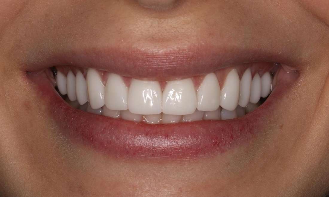 Close up of womans mouth after getting cosmetic/cerec crowns in brentwood, tn