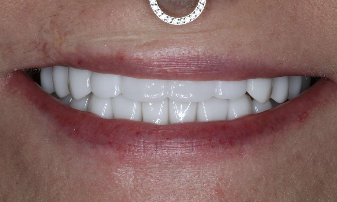 Close up view of after full mouth smile makeover, nashville tn