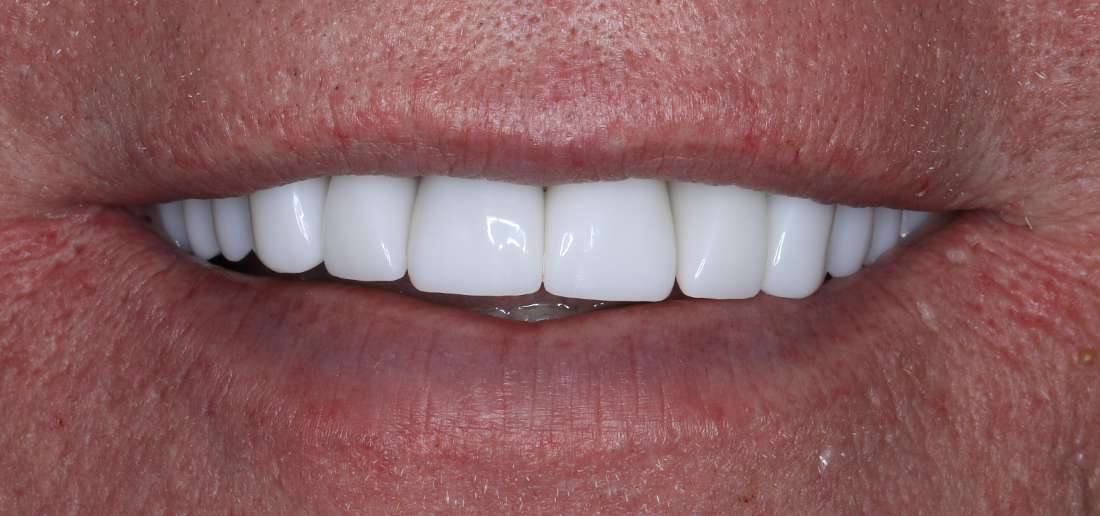 Close up of man smiling after full smile makeover, nashville tn