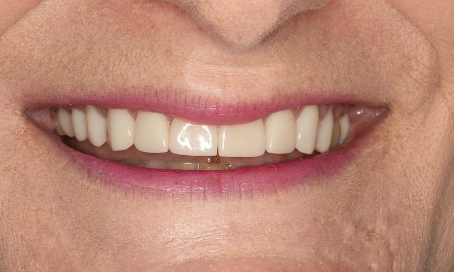 Close up of older womans mouth after cosmetic crowns, brentwood tn