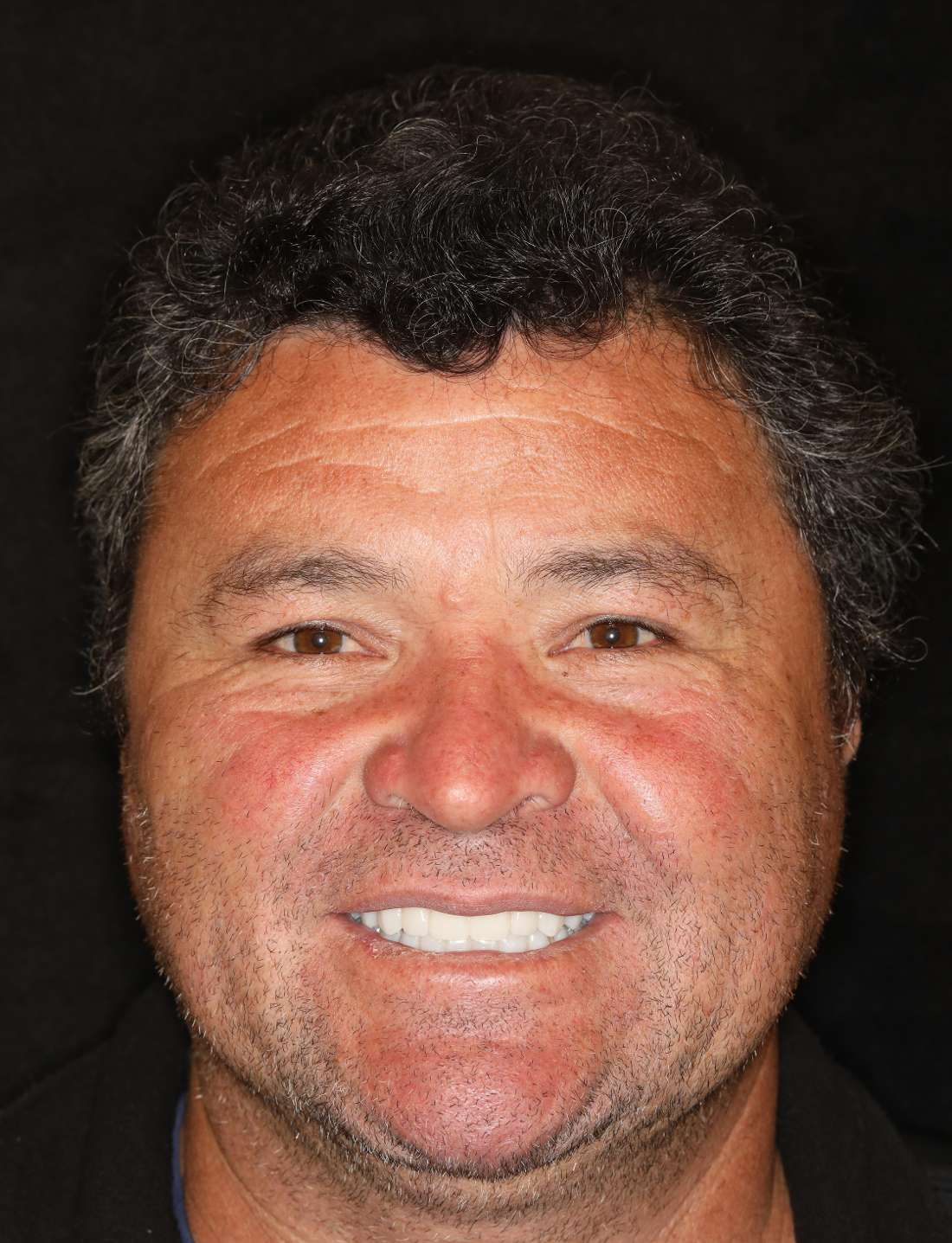 Nashville implant supported dentures- After Photo