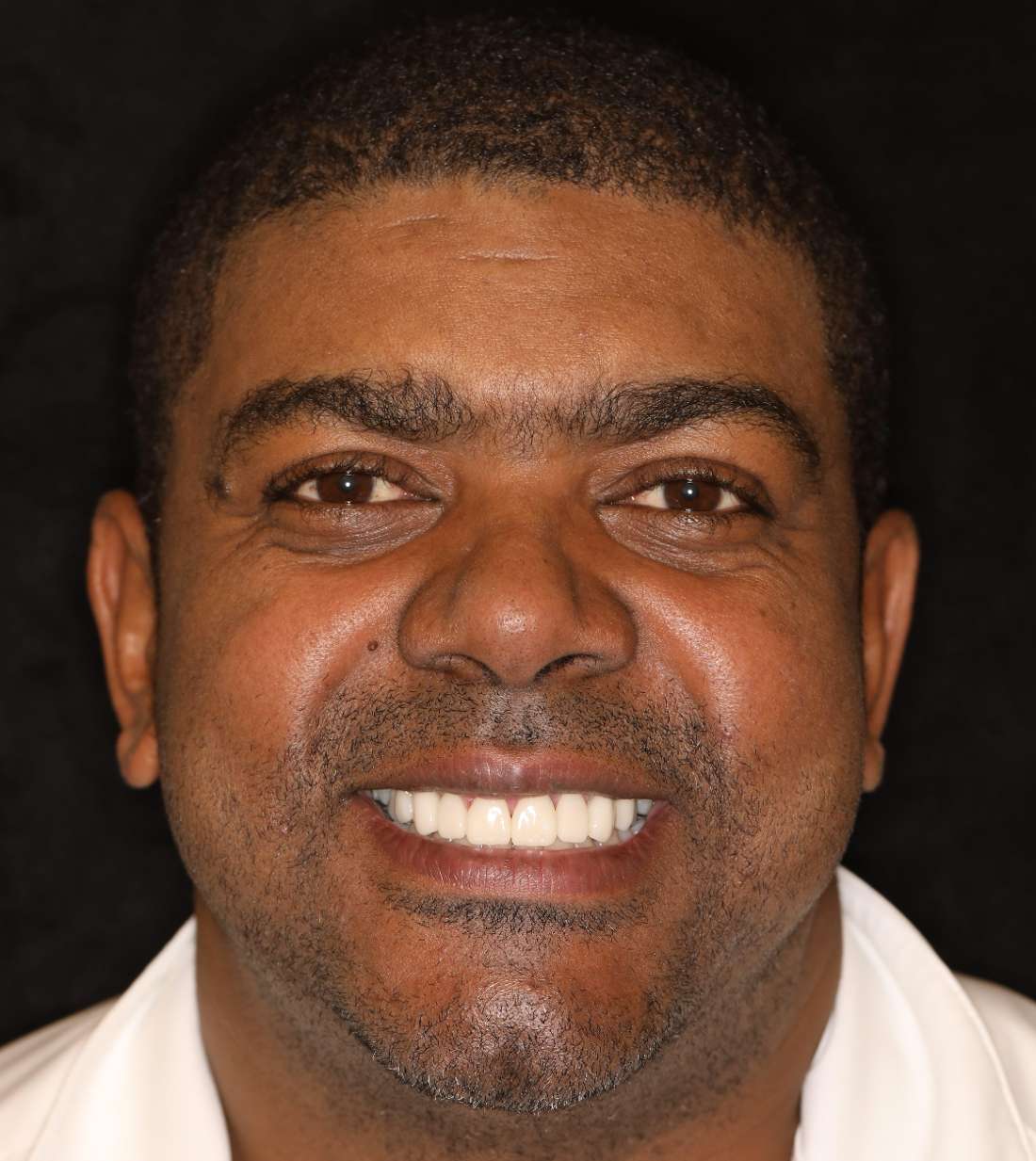 Brentwood, TN dental crowns- After Photo