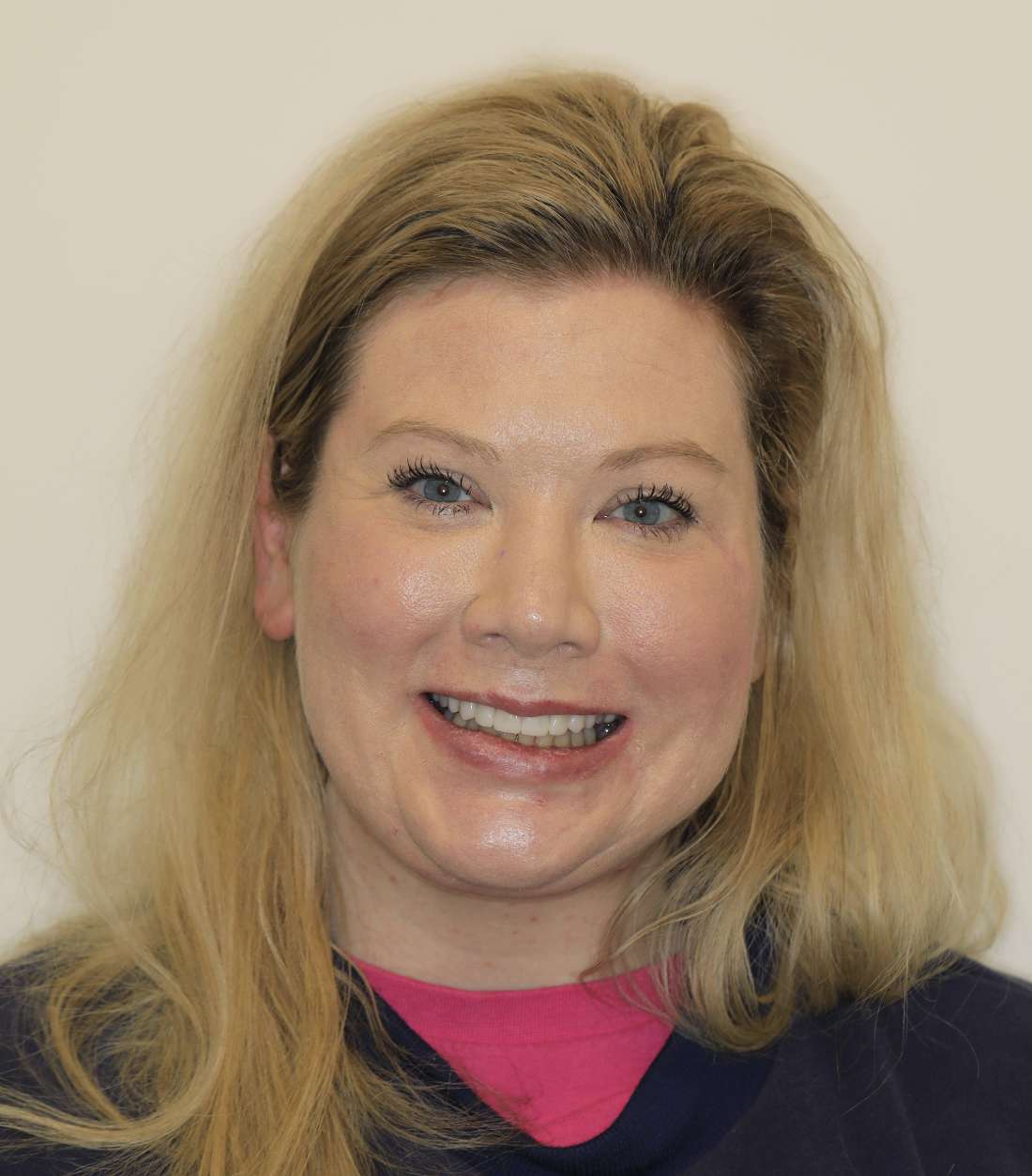 Brentwood Crowns- After Photo