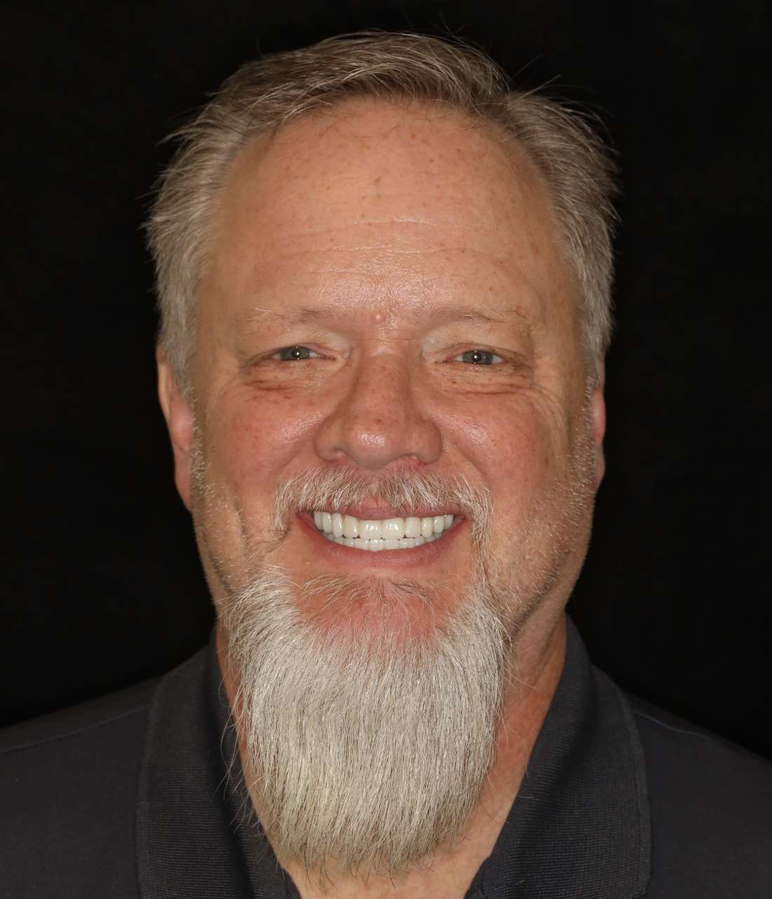 Implant Dentures, Nashville- After Photo