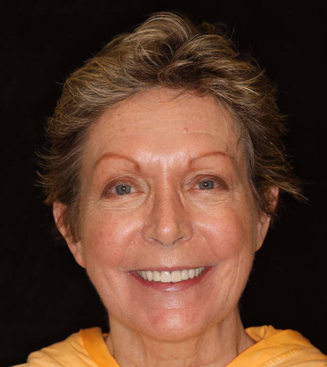 Brentwood CEREC Crowns- After Photo