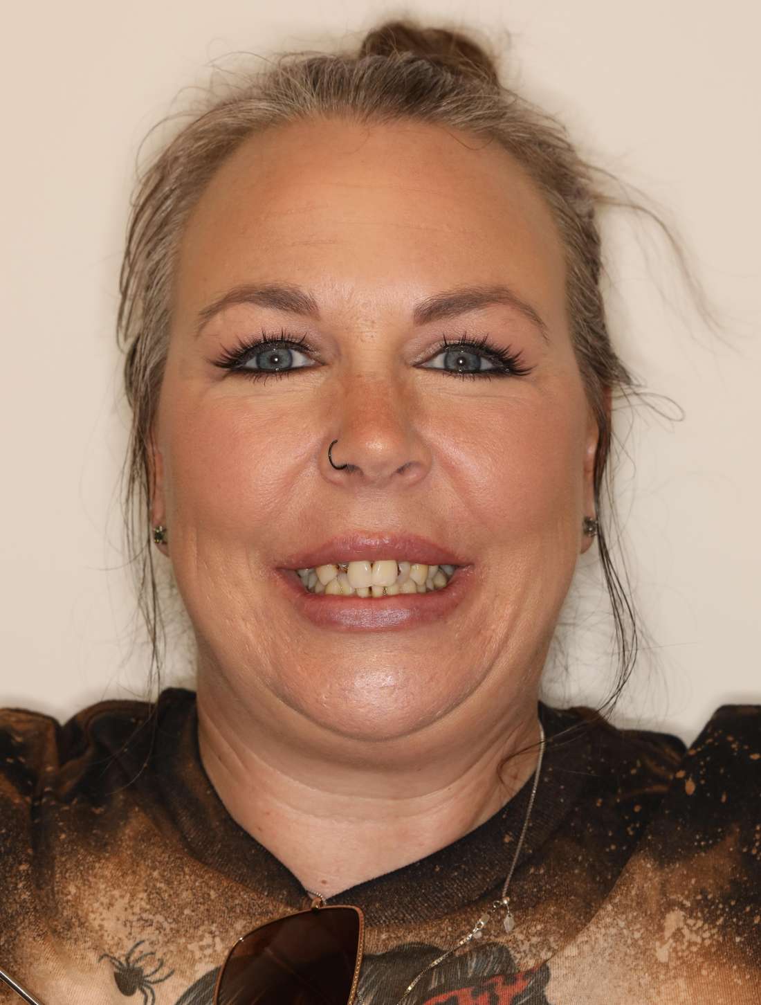 Middle aged woman smiling before all-on-x implant dentures, nashville tn