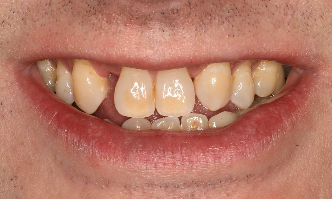 Before cosmetic crowns and bridges in Brentwood, TN