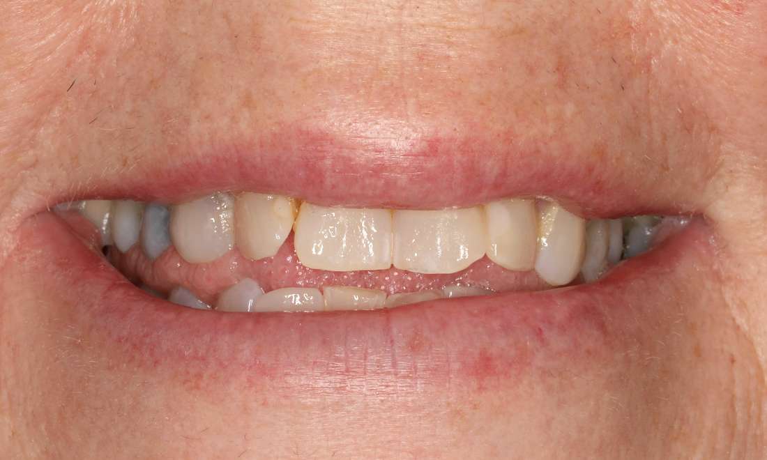 Patient teeth before cosmetic crowns Brentwood, TN