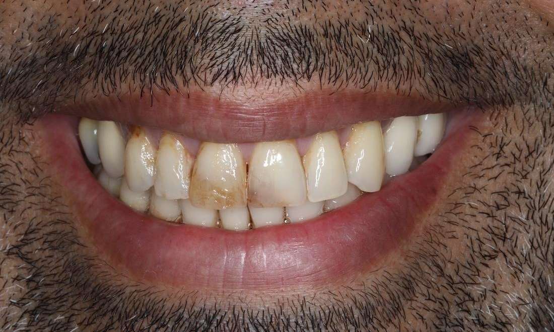 Close up of mans mouth with black facial hair before cosmetic crowns, brentwood tn