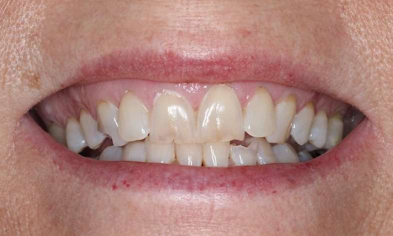 Close up of white womans mouth before cosmetic crowns, brentwood tn