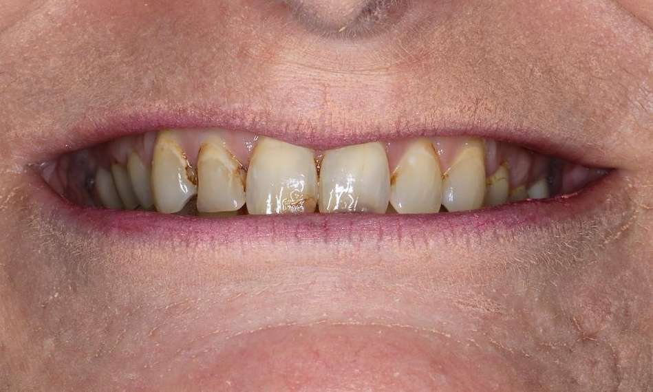 Close up of older womans mouth before cosmetic crowns, brentwood tn
