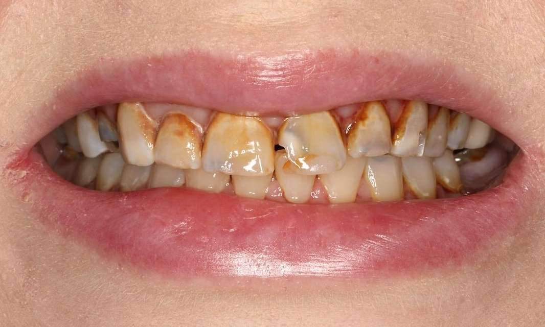 Close up of middle aged womans mouth before cosmetic crowns, brentwood tn