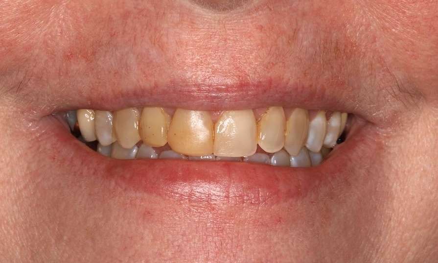 Close up view of womans mouth before cosmetic crowns, brentwood tn