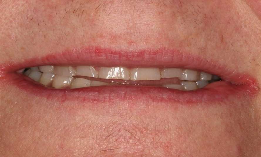 Mouth before cosmetic crowns, brentwood tn