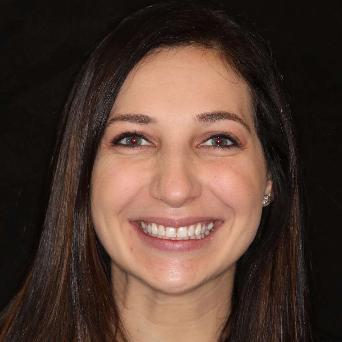 Before picture of a woman getting cosmetic/cerec crowns in brentwood, tn