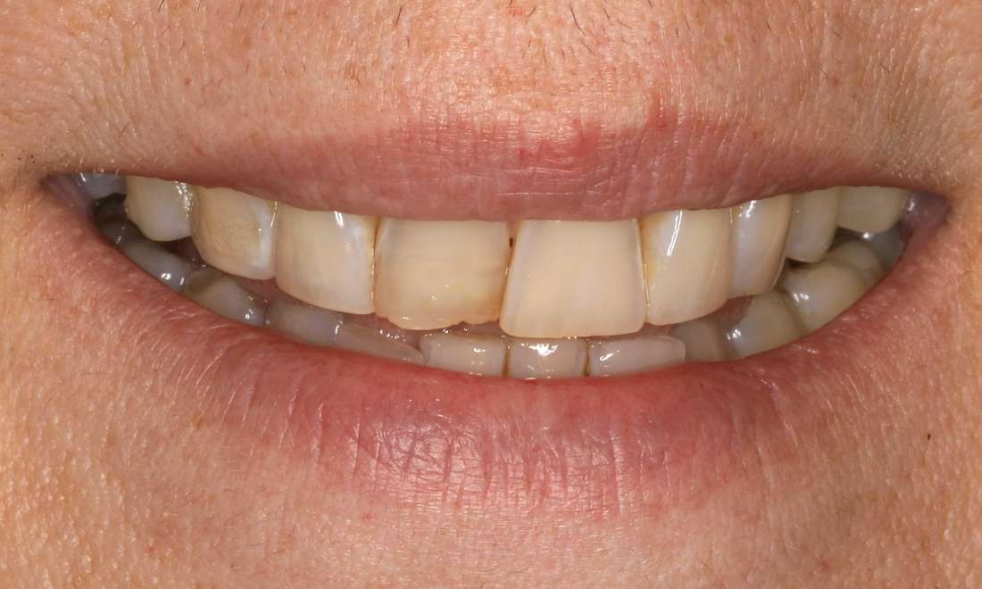 Before cosmetic dentistry in Brentwood, TN