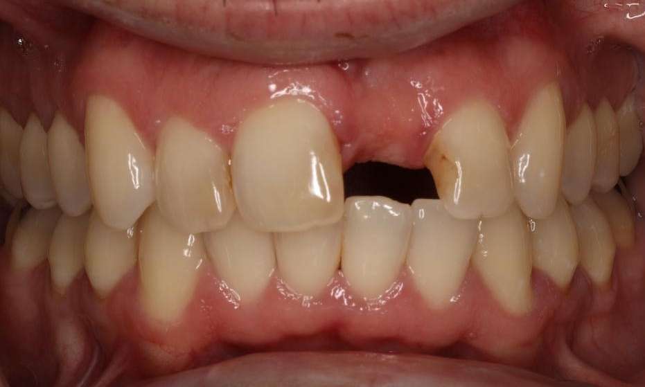 Close up of mouth before dental bridge, brentwood tn