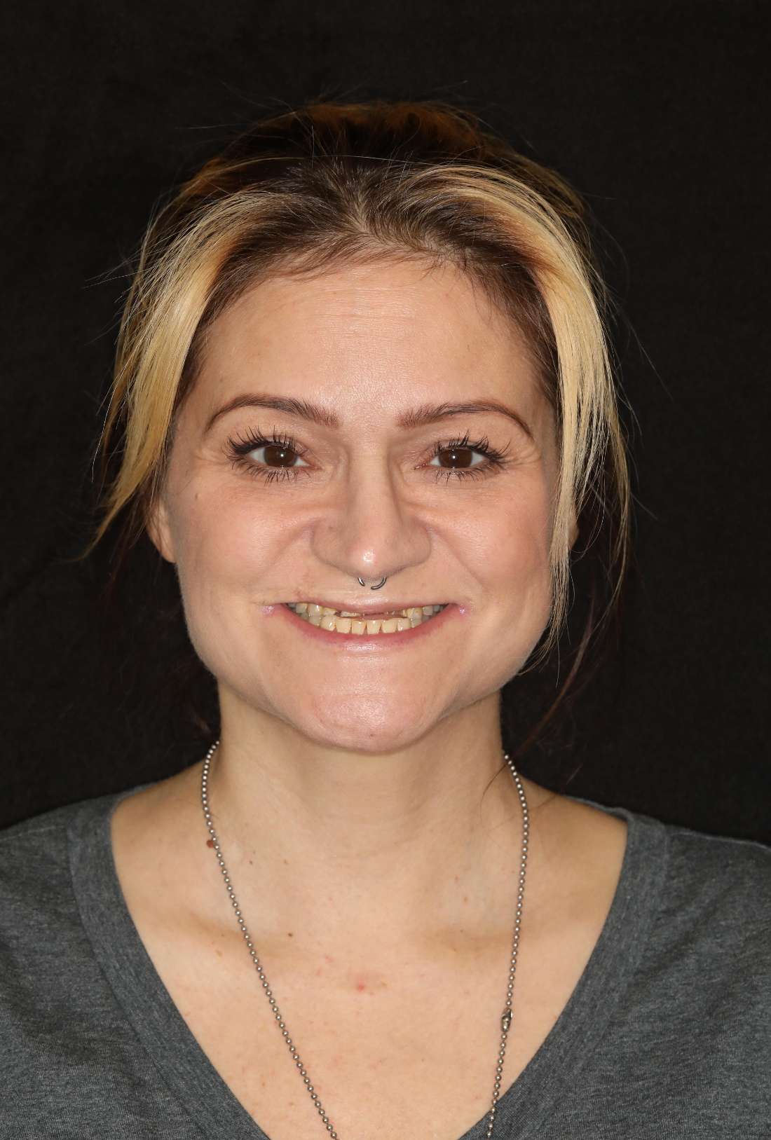 Before of full mouth smile makeover, nashville tn