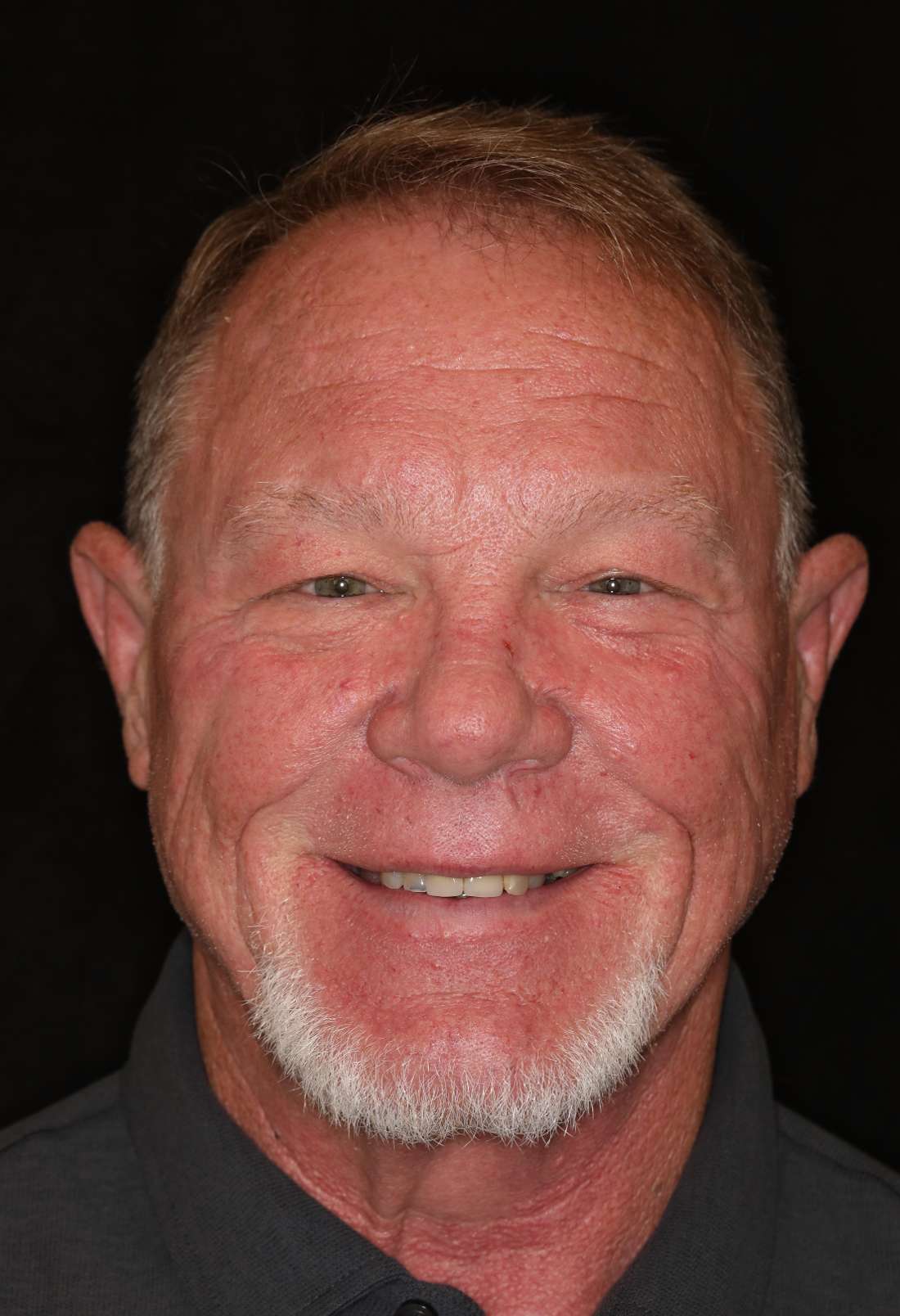 Man smiling before full smile makeover, nashville tn