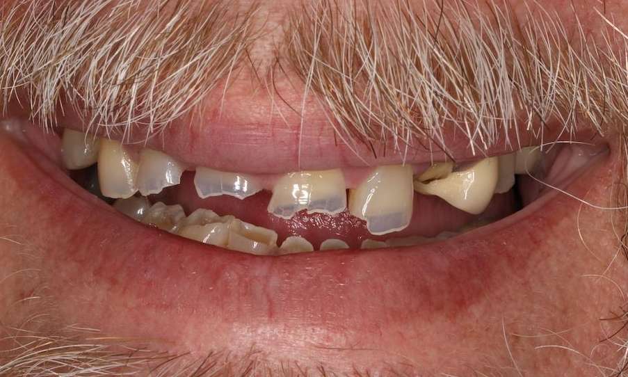 Close up of older mans mouth with mustace before implant dentures, nashville tn