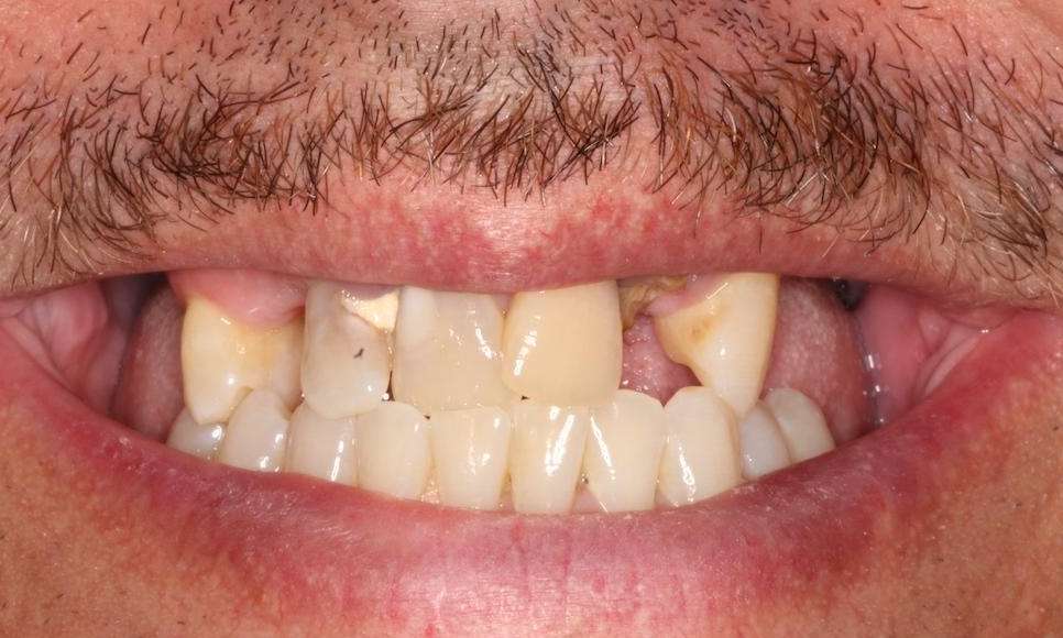 Mans mouth with a mustache before implant dentures, nashville tn