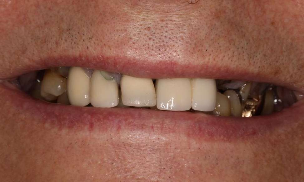 Mouth before implant dentures, nashville tn