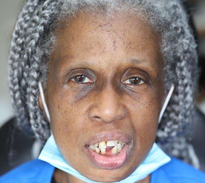Black womans mouth before implant dentures, nashville tn