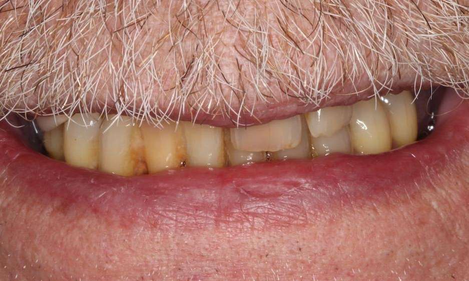 Close of older mans teeth with a white mustache before implant-supported dentures, Nashville tn