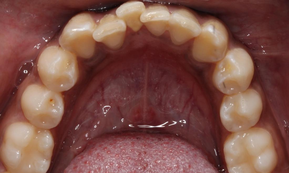 Patient teeth before Invisalign