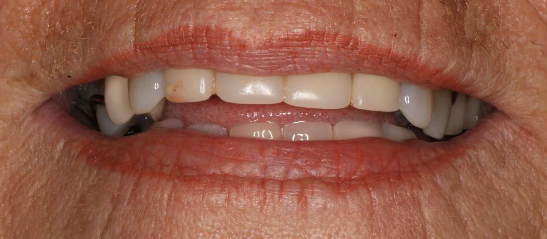 Close up view of older woman's smile before a smile makeover, nashville tn