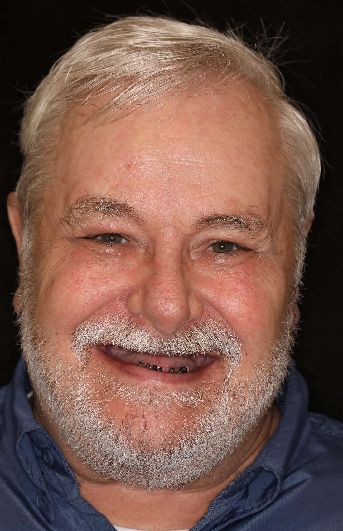 Before picture of a man before a Top Denture and Bottom Implant Snap In Denture, nashville tn