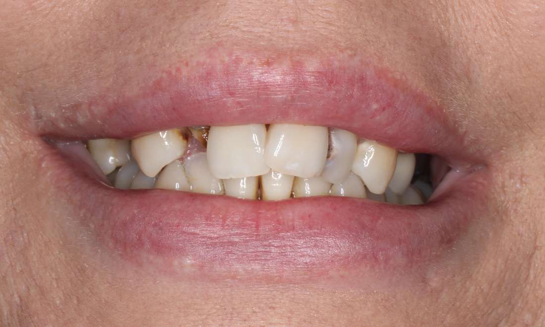 Close up view of middle aged woman smiling before all-on-x implant dentures, nashville tn
