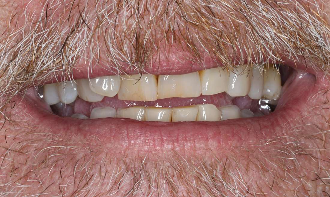 Close up view of older man smiling before all-on-x implant dentures, nashville tn