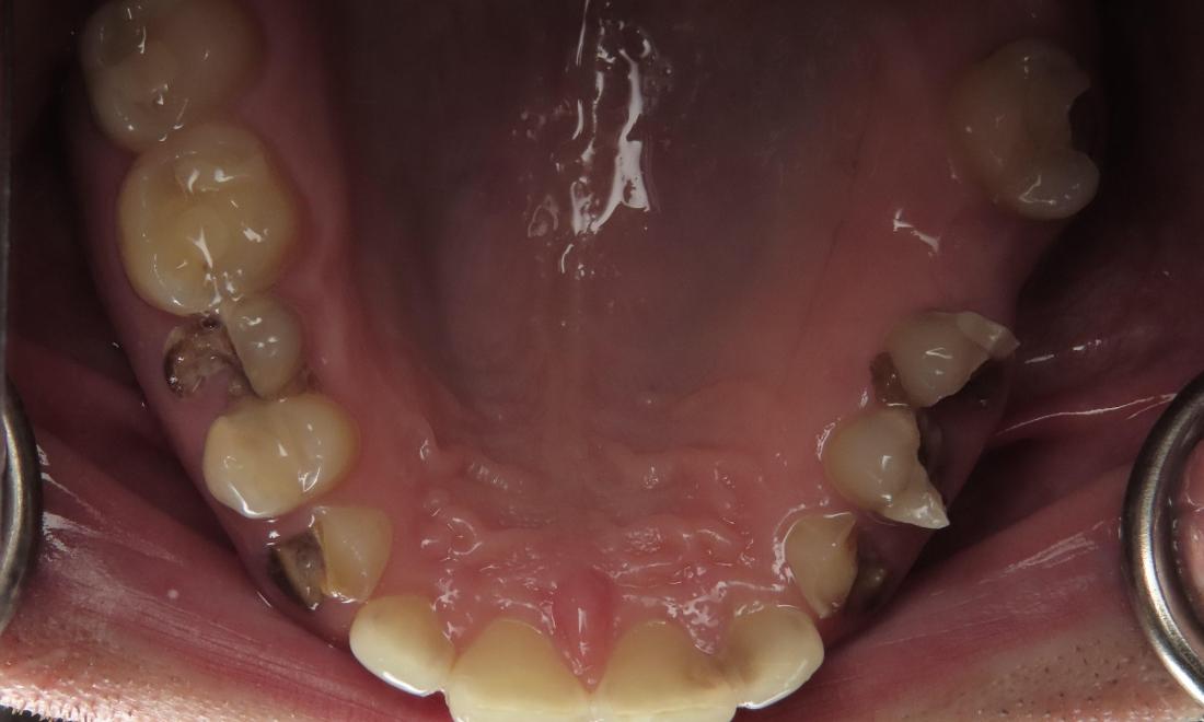 Overhead view of mouth before complete smile makeover, nashville tn